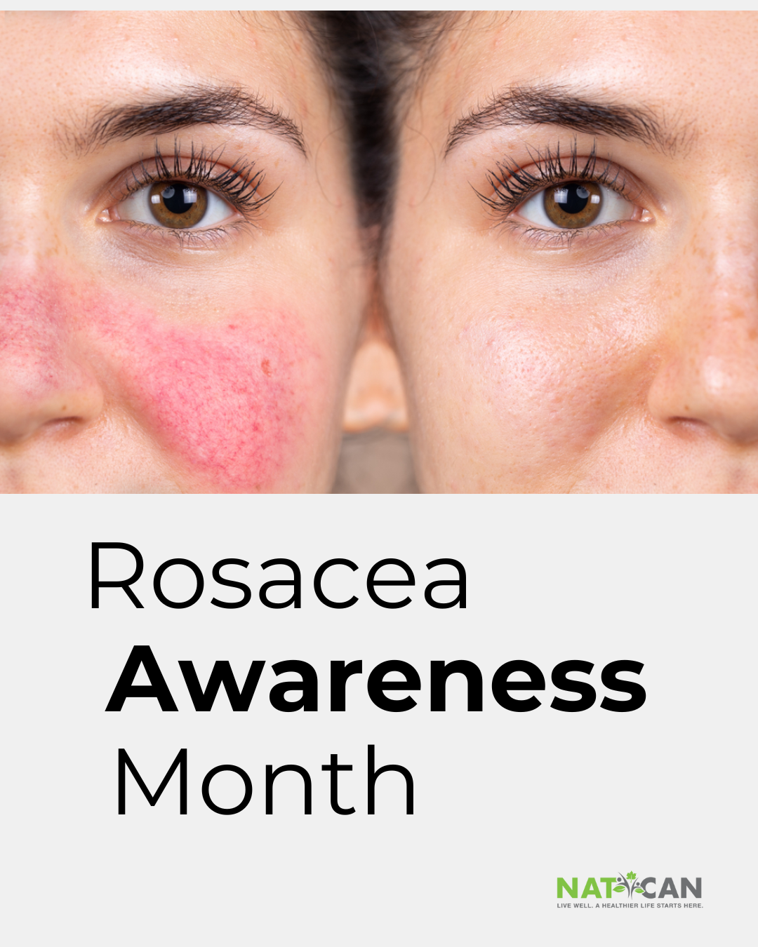 April is Rosacea Awareness Month: Let’s Talk About It