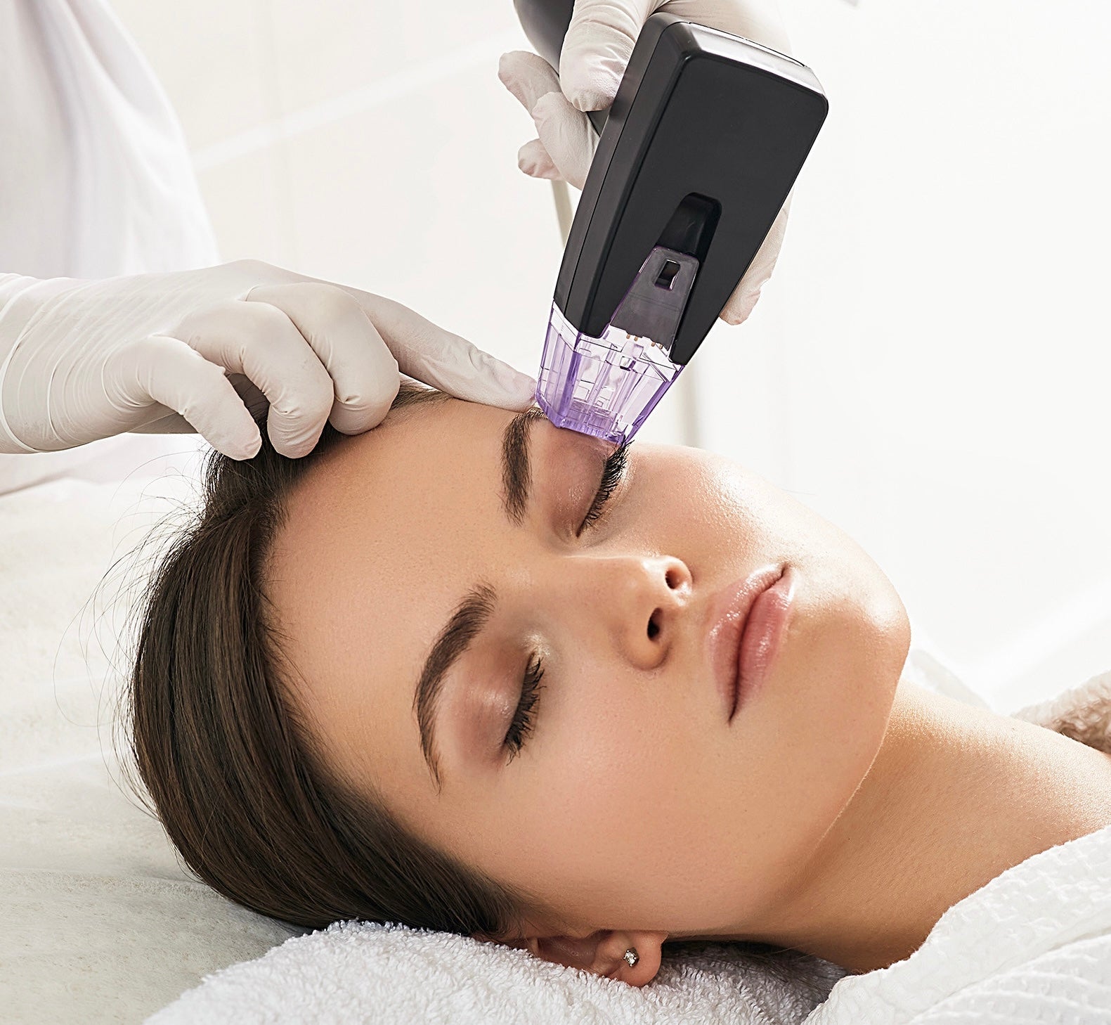 Best Acne Scar Treatments in Vaughan: Morpheus8 vs Microneedling