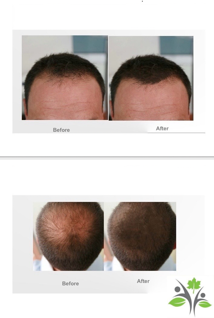 Hair Restoration Treatments: Exploring PRP and Exosome Therapy