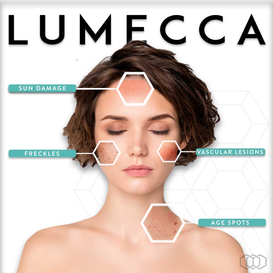 Discover the Treatment of Lumecca: Superior Solution for Skin Complexion