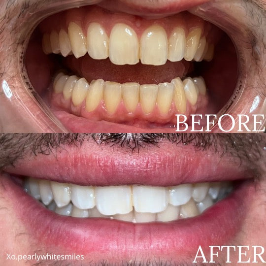 This photo is divided into before and after segments to showcase a yellowing smile versus a brighter smile after teeth whitening treatment.