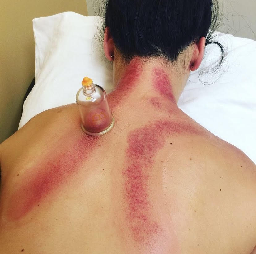 A brunette woman laying on an acupuncture table receives cupping treatment for back pain