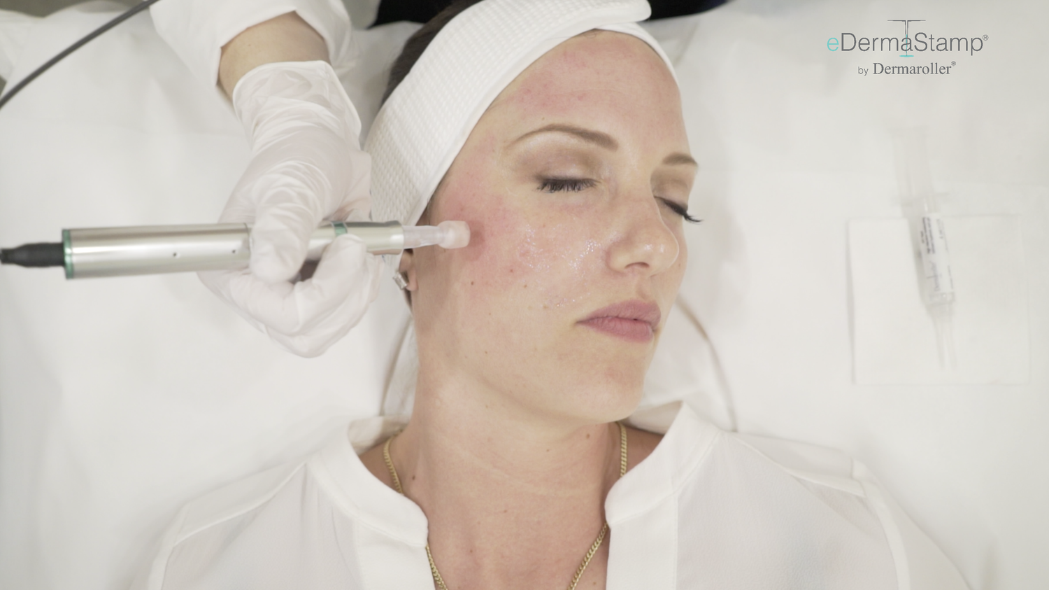 Microneedling with eDermaStamp® by DermaSpark