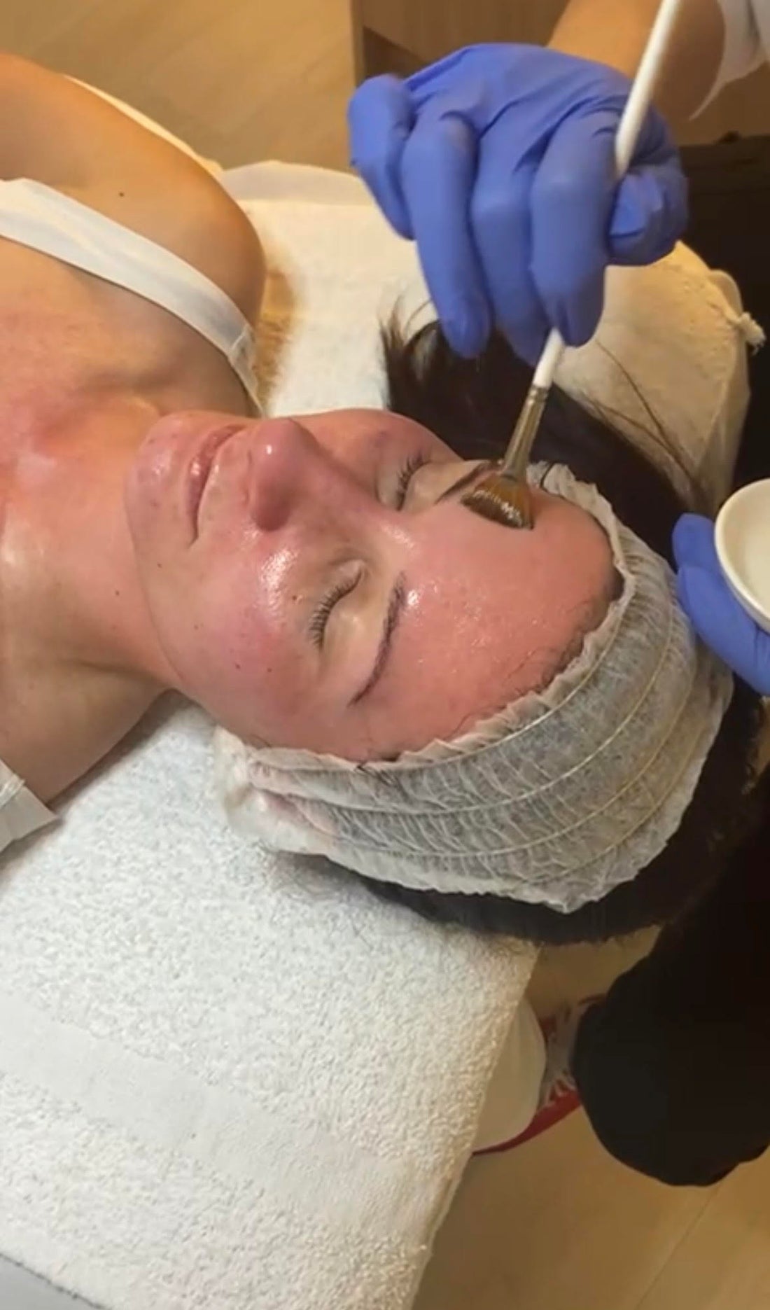 AlumierMD Peel – Medical-Grade Chemical Peel